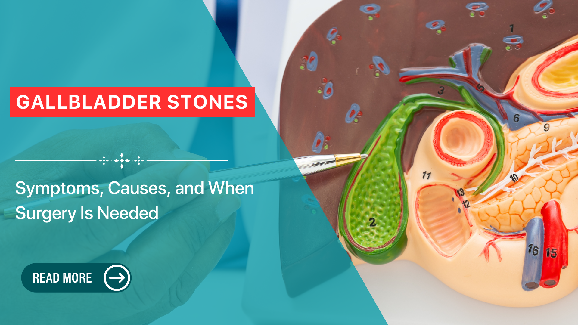 Gallbladder Stones: Symptoms, Causes, and When Surgery Is Needed