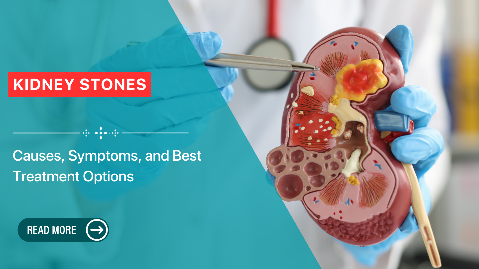 Kidney Stones: Causes, Symptoms, and Best Treatment Options